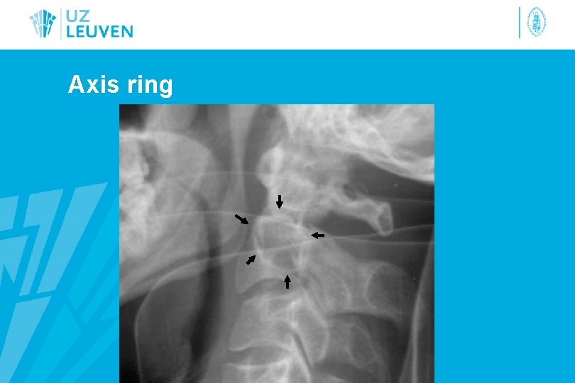 Axis ring 