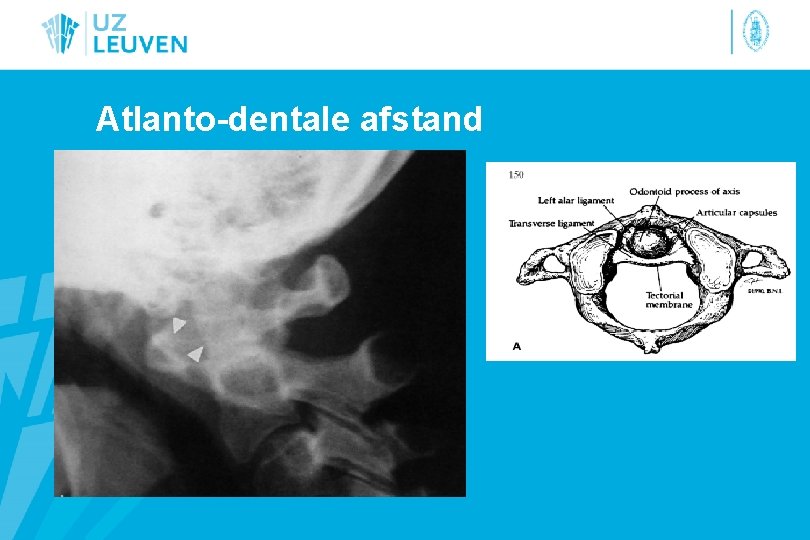 Atlanto-dentale afstand 