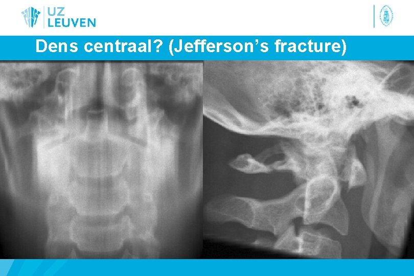 Dens centraal? (Jefferson’s fracture) 