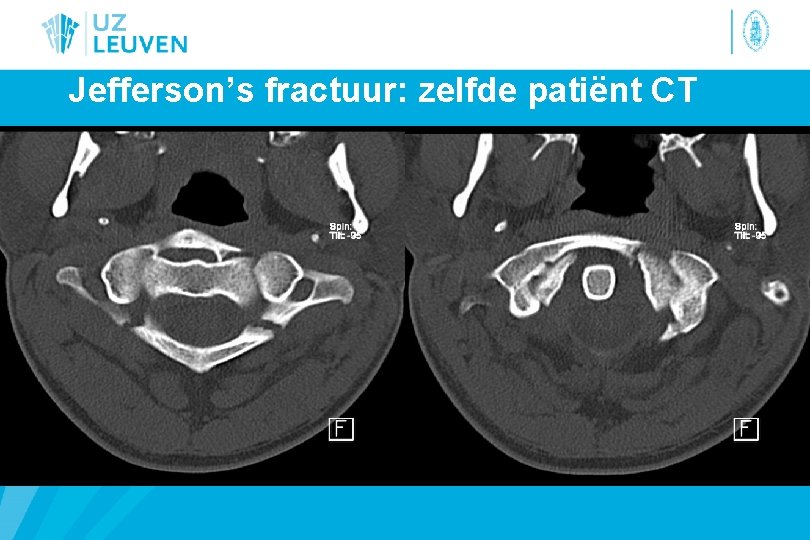 Jefferson’s fractuur: zelfde patiënt CT 