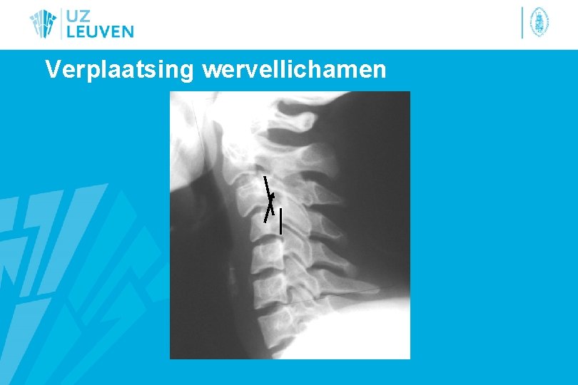 Verplaatsing wervellichamen 