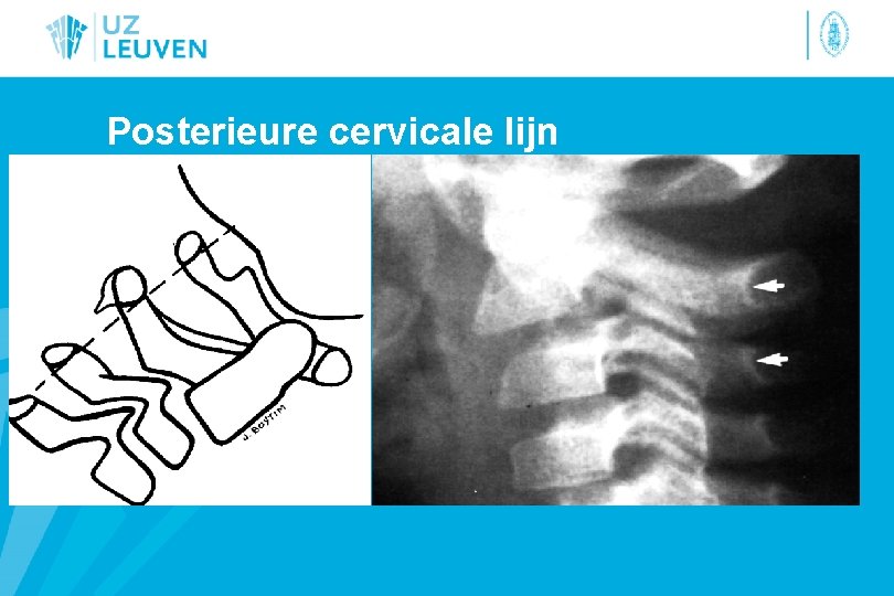 Posterieure cervicale lijn 