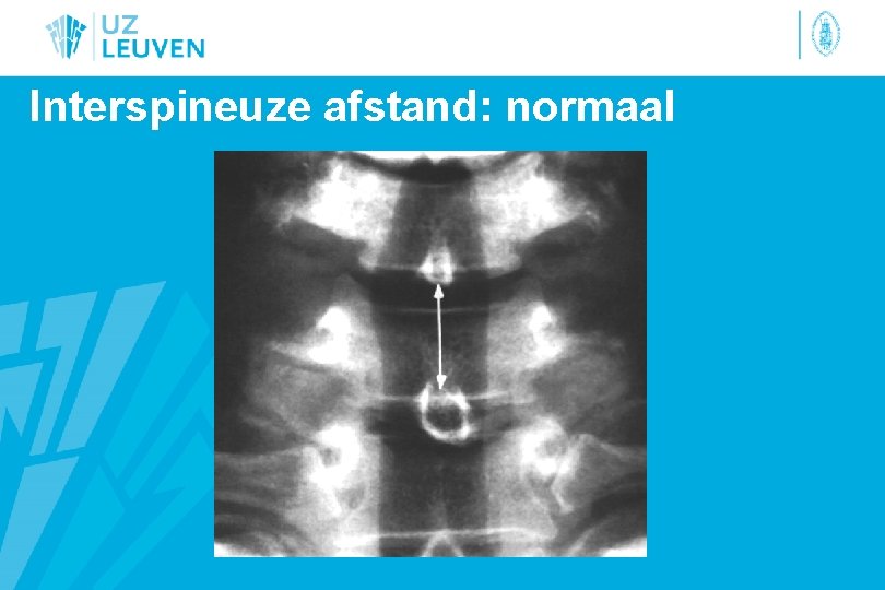 Interspineuze afstand: normaal 