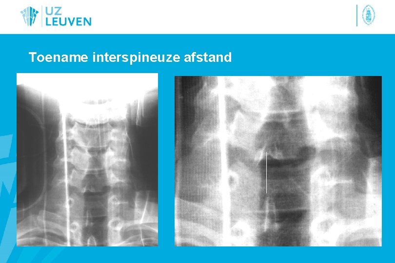 Toename interspineuze afstand 