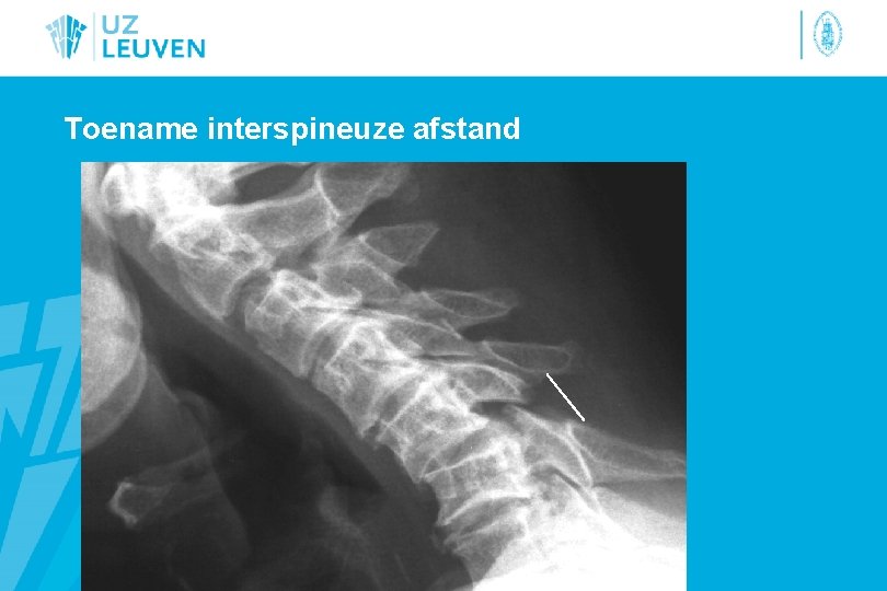 Toename interspineuze afstand 