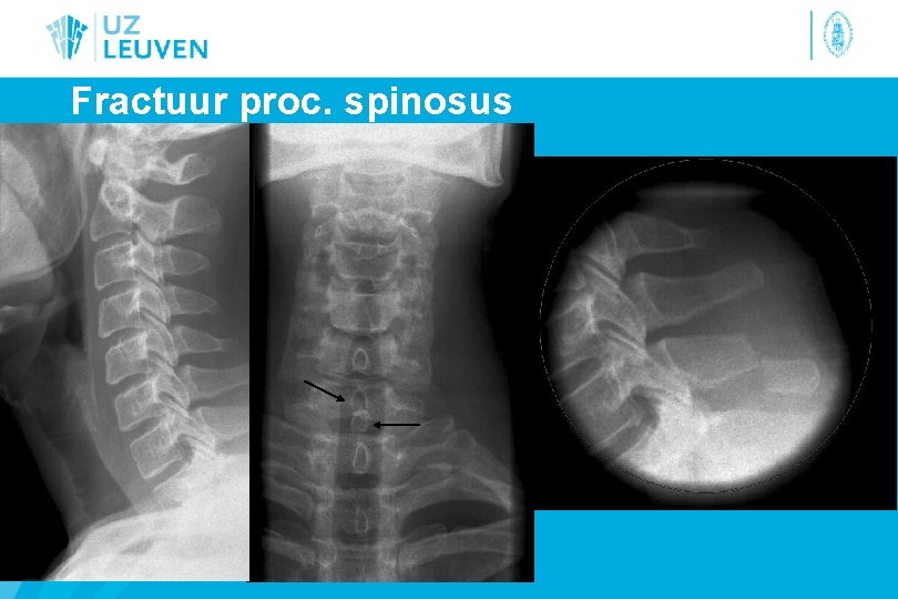Fractuur proc. spinosus 