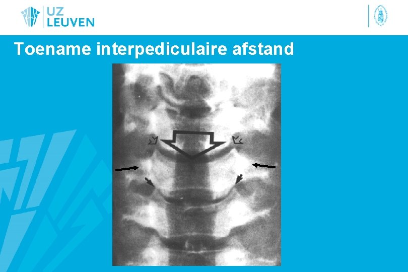 Toename interpediculaire afstand 