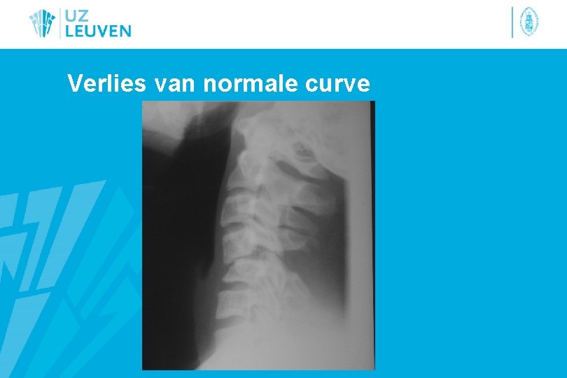 Verlies van normale curve 