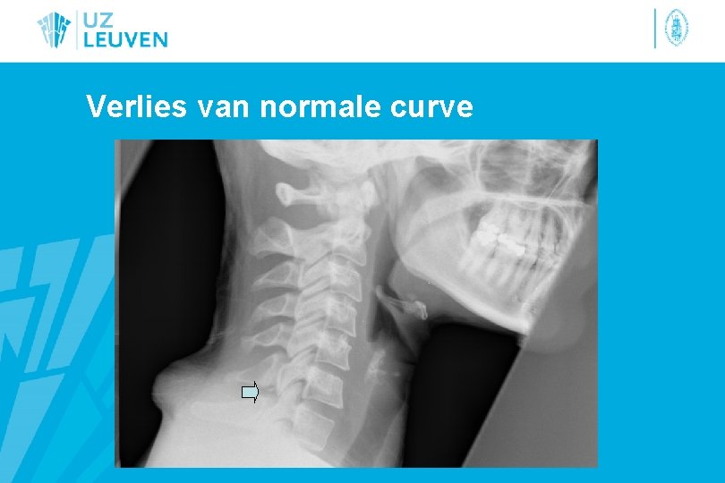 Verlies van normale curve 