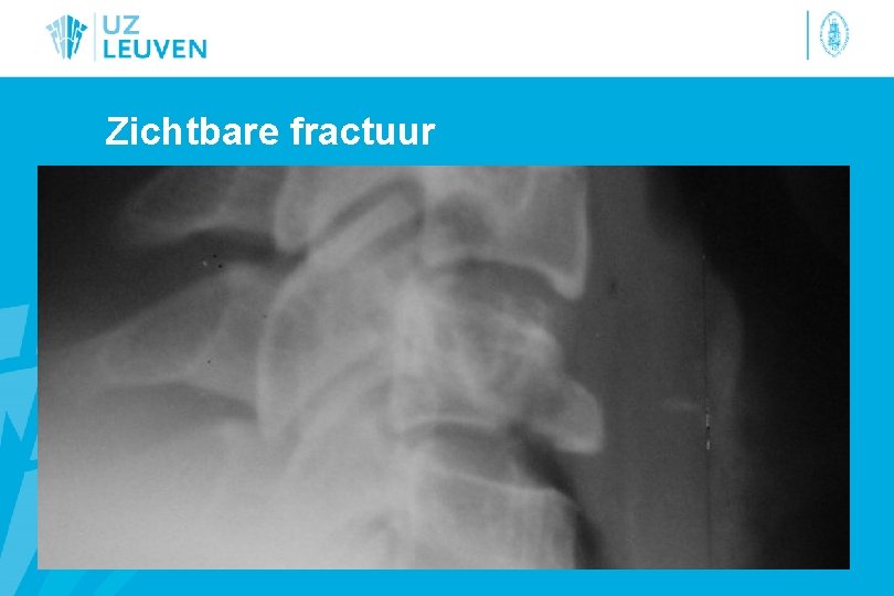 Zichtbare fractuur 
