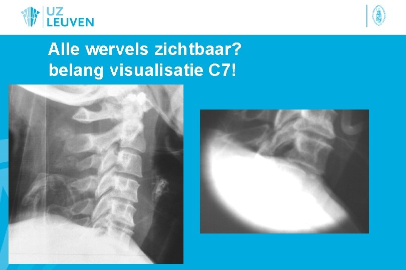 Alle wervels zichtbaar? belang visualisatie C 7! 