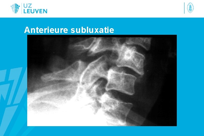 Anterieure subluxatie 