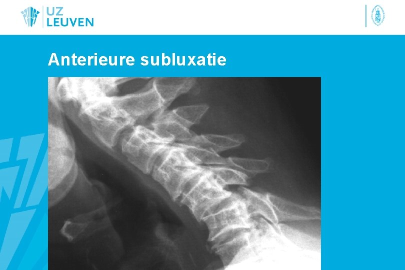 Anterieure subluxatie 