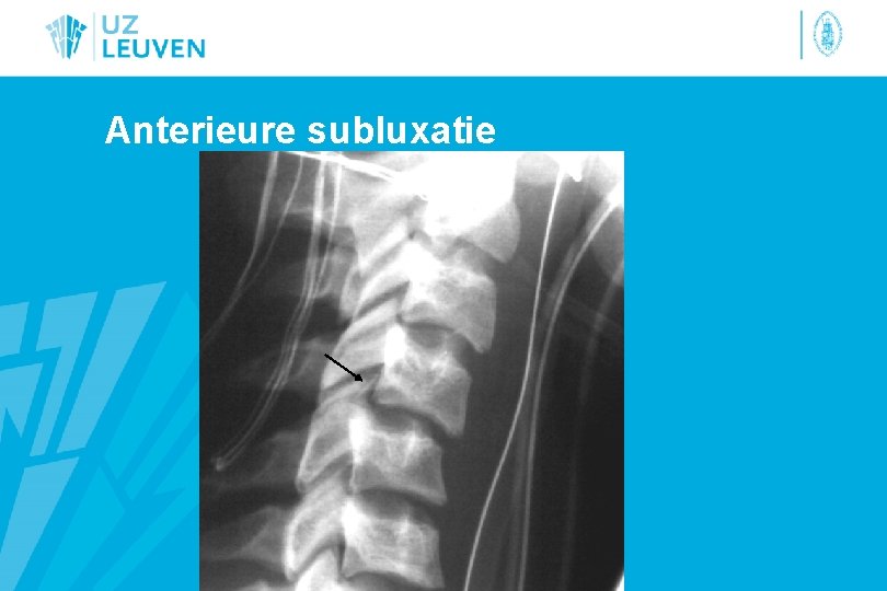 Anterieure subluxatie 