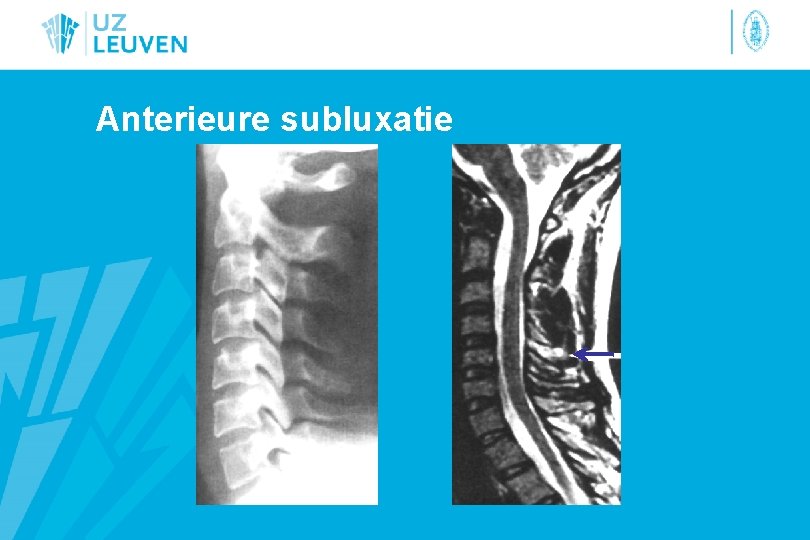 Anterieure subluxatie 