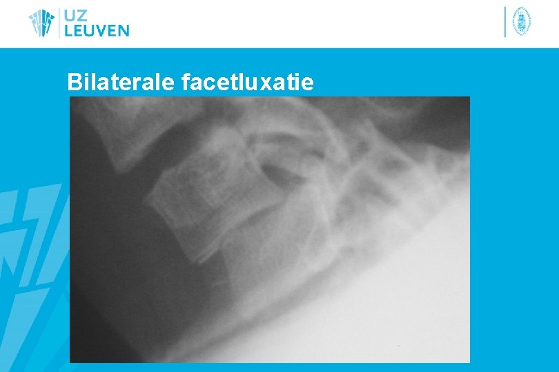 Bilaterale facetluxatie 