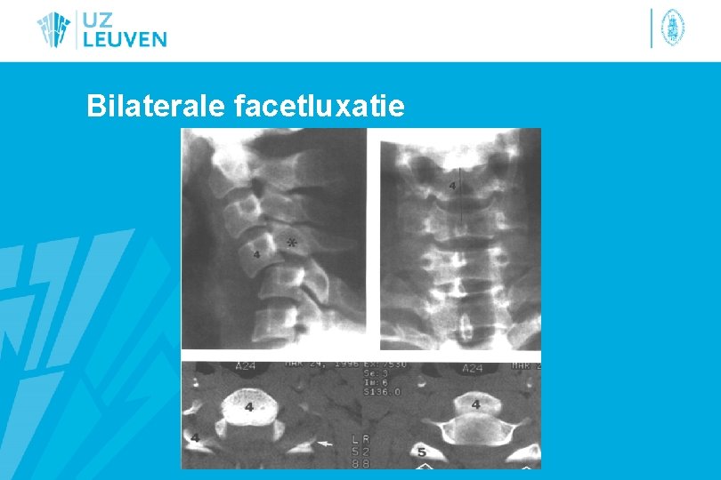 Bilaterale facetluxatie 