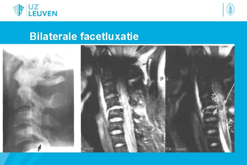 Bilaterale facetluxatie 