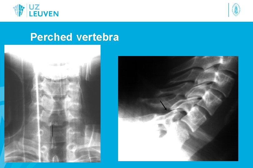 Perched vertebra 