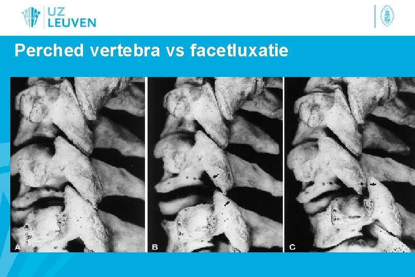 Perched vertebra vs facetluxatie 
