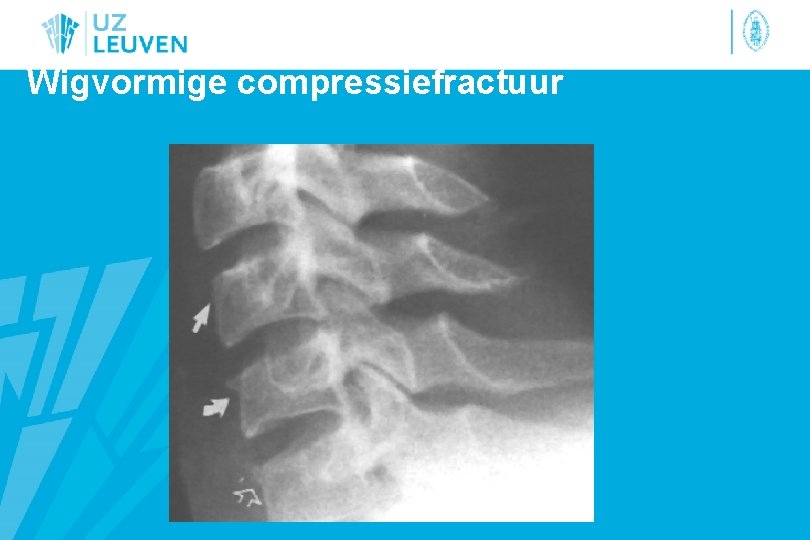 Wigvormige compressiefractuur 