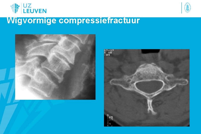 Wigvormige compressiefractuur 