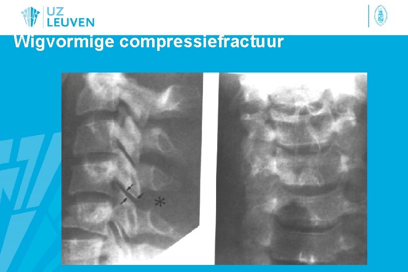 Wigvormige compressiefractuur 