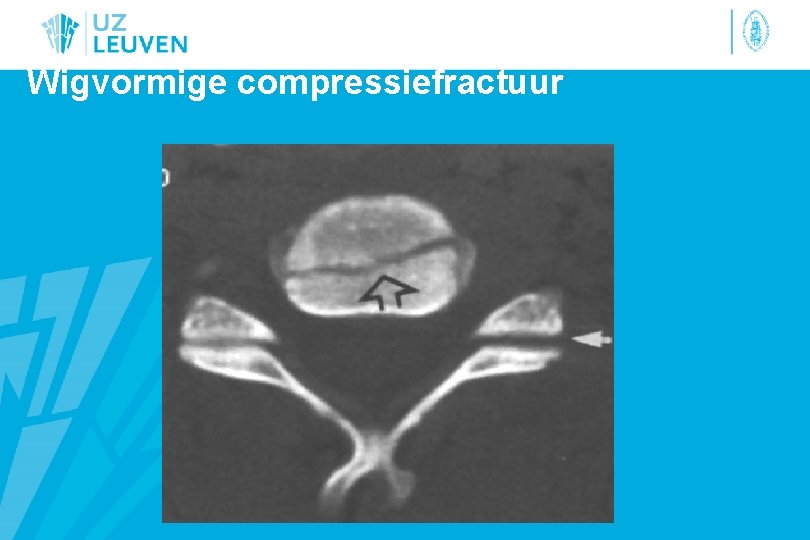 Wigvormige compressiefractuur 