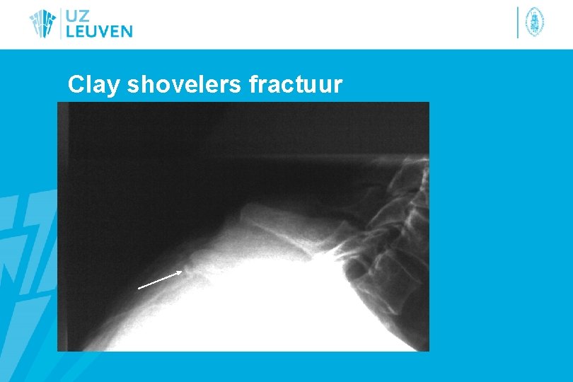 Clay shovelers fractuur 