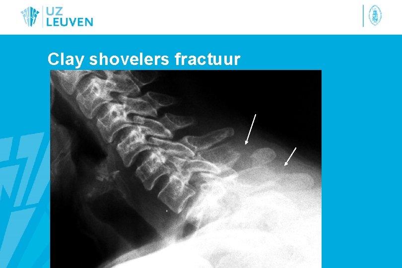 Clay shovelers fractuur 