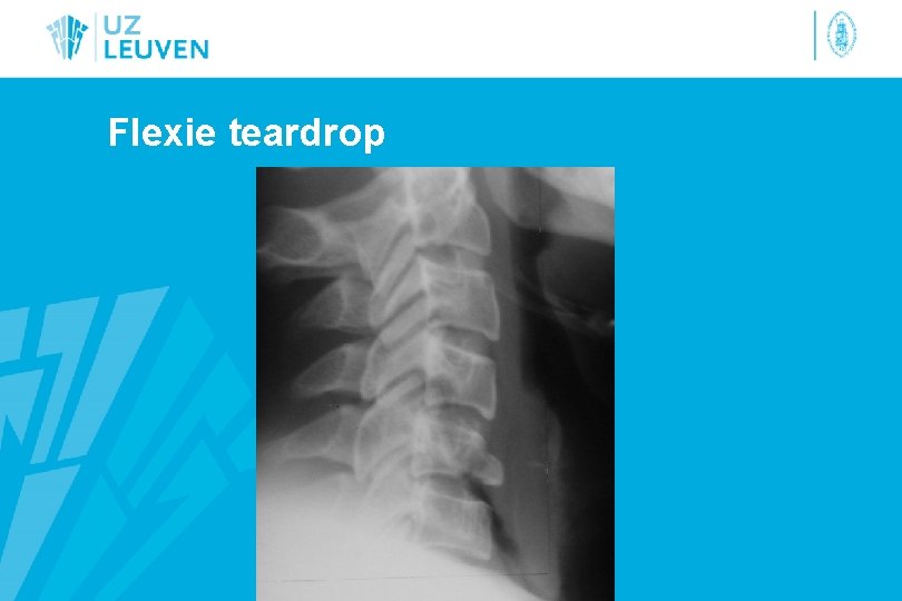 Flexie teardrop 
