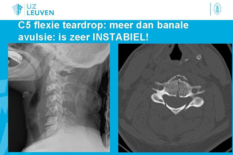 C 5 flexie teardrop: meer dan banale avulsie: is zeer INSTABIEL! 