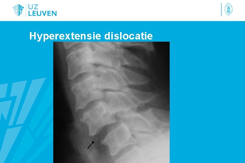 Hyperextensie dislocatie 
