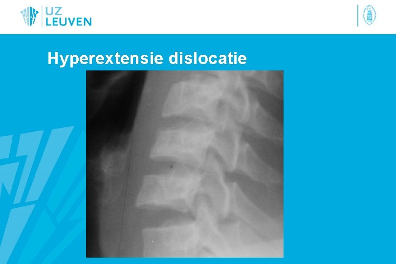 Hyperextensie dislocatie 