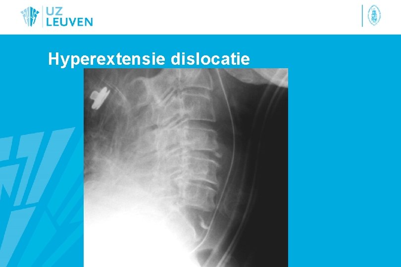 Hyperextensie dislocatie 