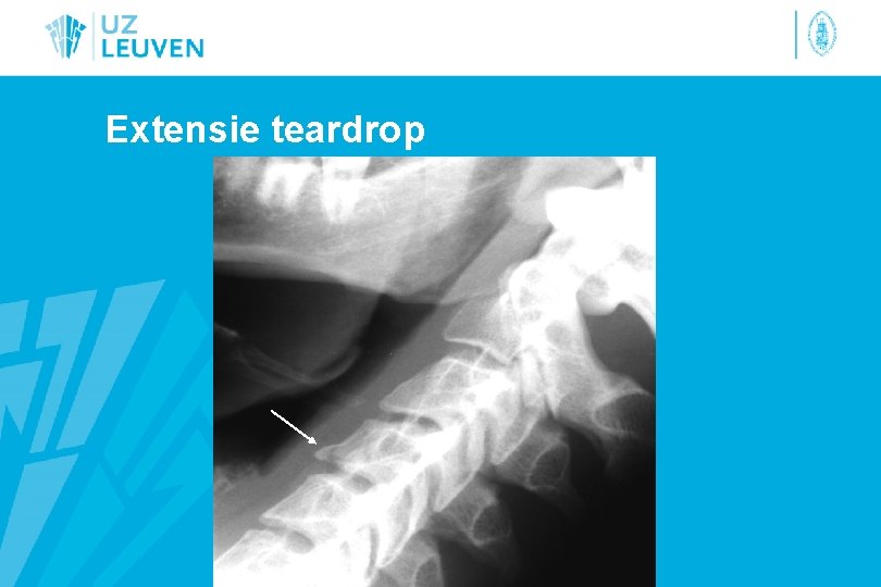 Extensie teardrop 