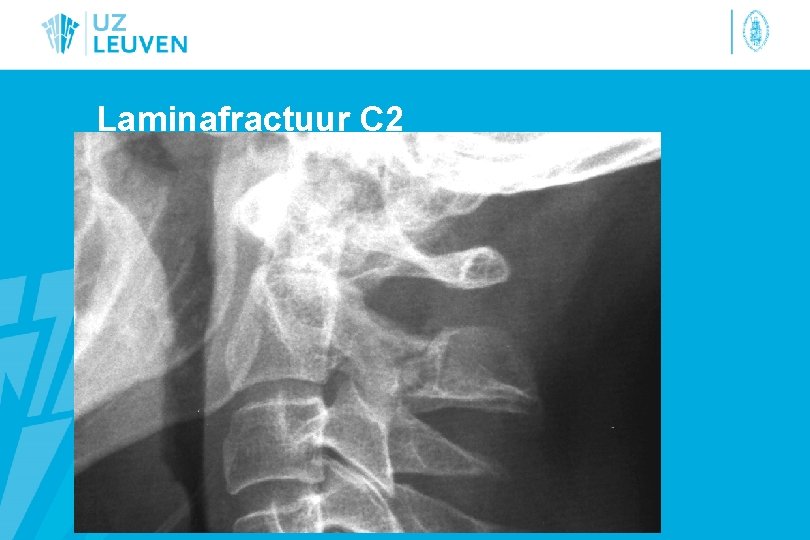 Laminafractuur C 2 