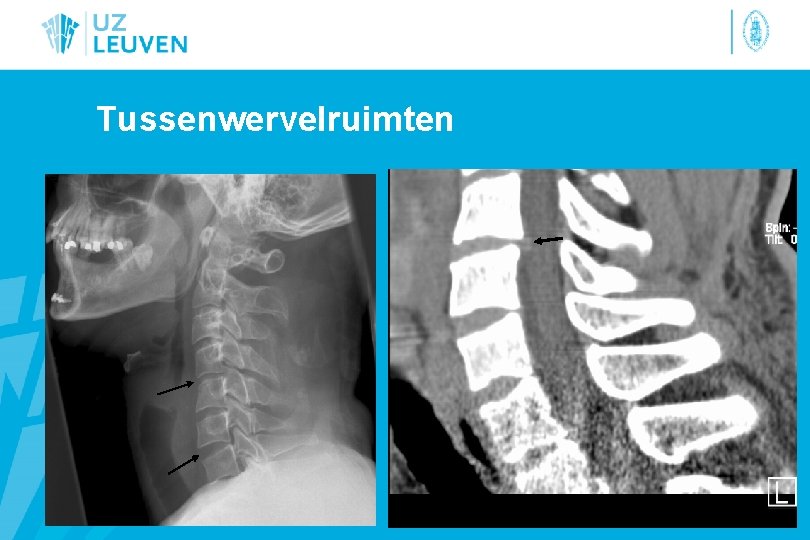 Tussenwervelruimten 
