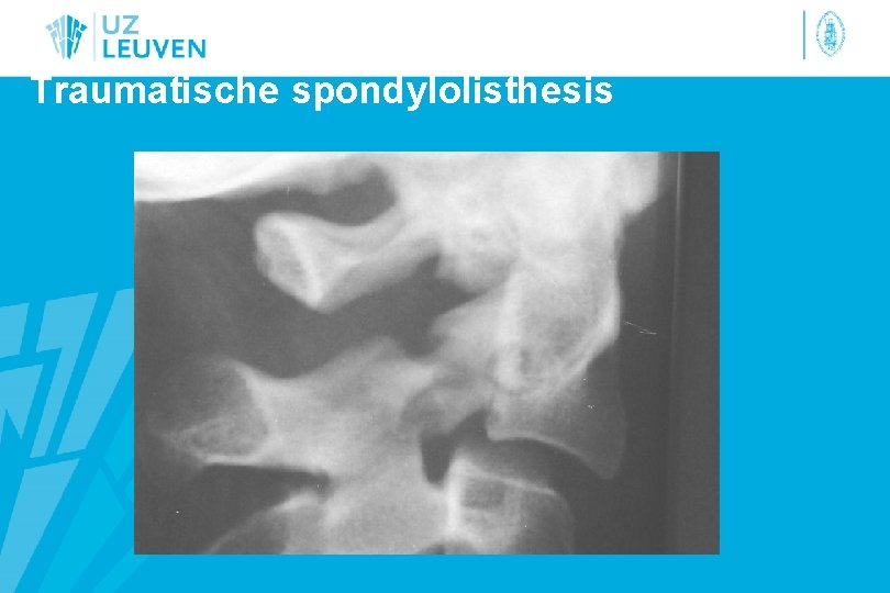 Traumatische spondylolisthesis 