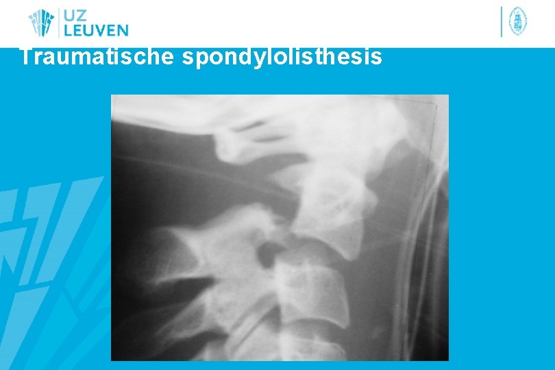 Traumatische spondylolisthesis 