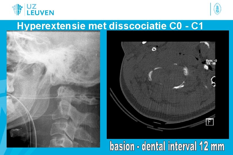 Hyperextensie met disscociatie C 0 - C 1 