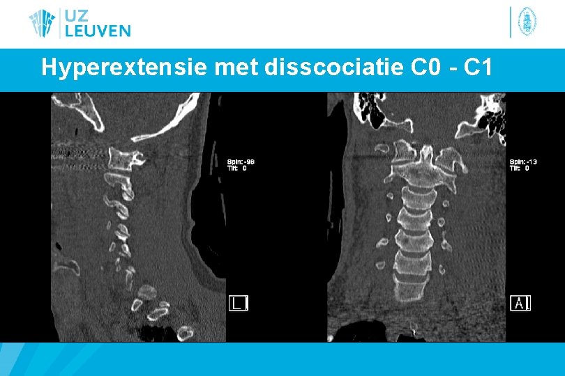 Hyperextensie met disscociatie C 0 - C 1 