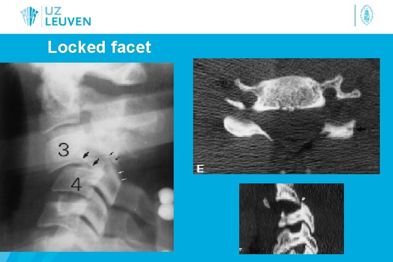 Locked facet 