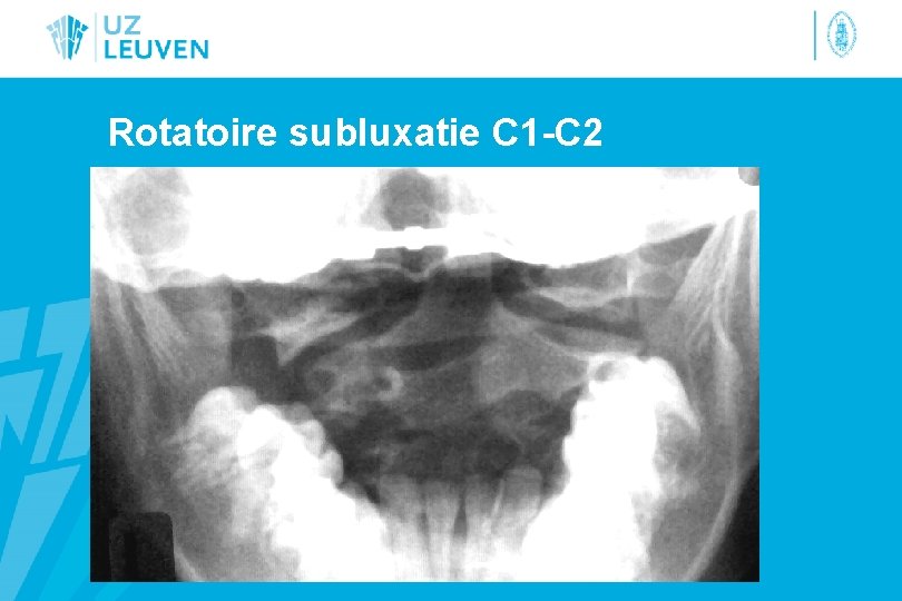 Rotatoire subluxatie C 1 -C 2 
