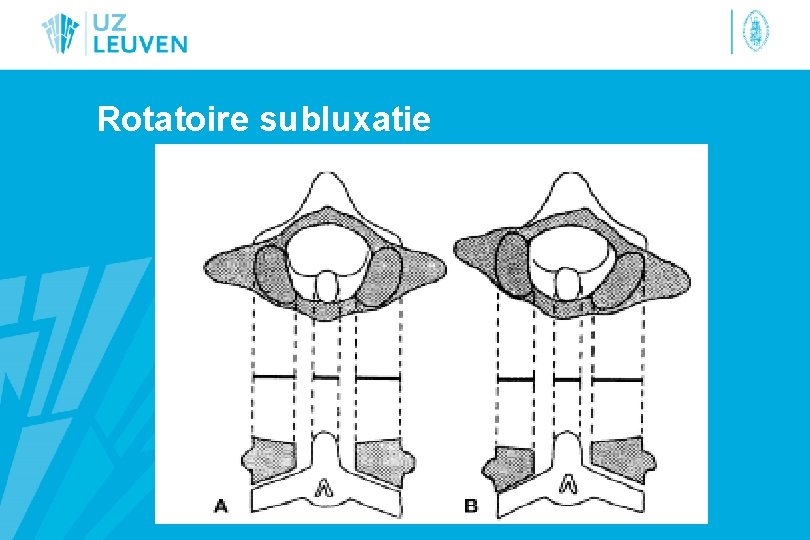 Rotatoire subluxatie 