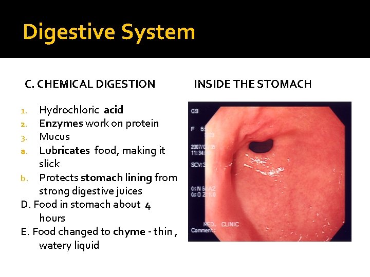 Digestive System C. CHEMICAL DIGESTION Hydrochloric acid Enzymes work on protein Mucus Lubricates food,