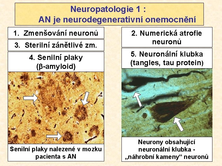 Neuropatologie 1 : AN je neurodegenerativní onemocnění 1. Zmenšování neuronů 3. Sterilní zánětlivé zm.