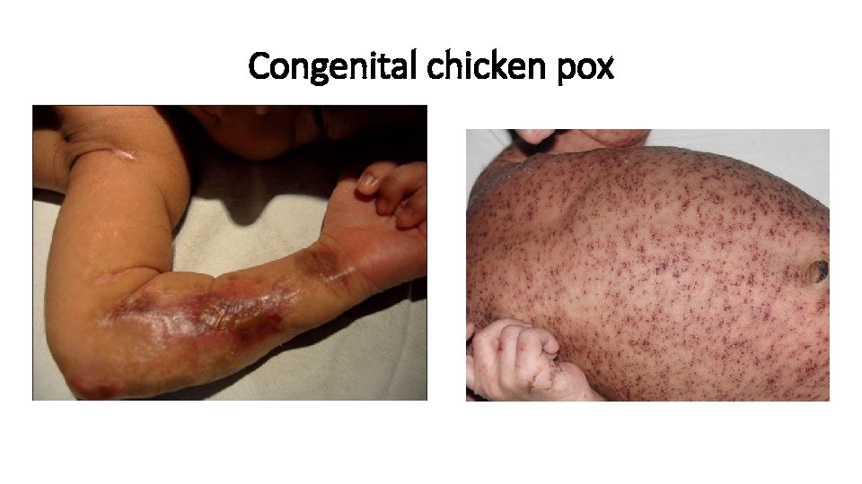 Congenital chicken pox 