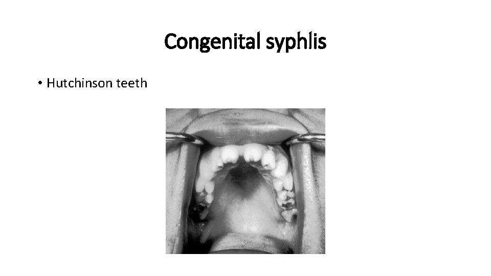Congenital syphlis • Hutchinson teeth 
