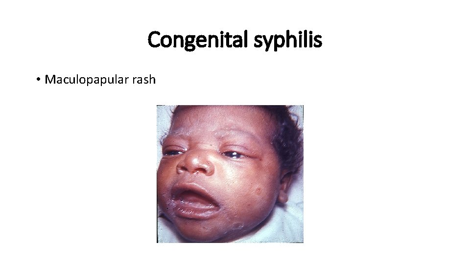 Congenital syphilis • Maculopapular rash 
